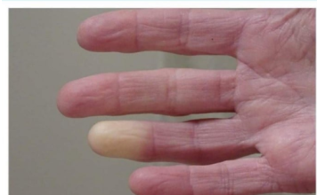 4 RAZLOGA ZAŠTO SU VAM RUKE I NOGE HLADNE: To je simptom, evo šta VAM SE DOGAĐA U ORGANIZMU