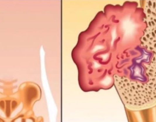 BOL U KOSTIMA, VISOK PRITISAK I TUGA Simptomi da vam u tijelu nedostaje ovaj VAŽAN VITAMIN