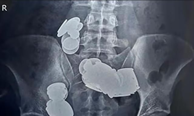 Muškarac tražio pomoć zbog jakih bolova u trbuhu, ljekari u nevjerici zbog onog što su našli