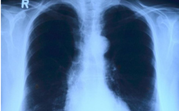 Opaka bolest u porastu, izdali upozorenje građanima: Ovo su simptomi