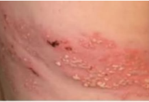 Najmoćniji PRIRODNI LIJEK za HERPES ZOSTER: uklonite ga zauvijek!