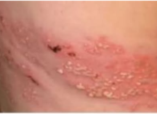 Najmoćniji PRIRODNI LIJEK za HERPES ZOSTER: uklonite ga zauvijek!