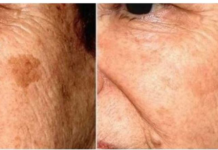 POZNATI DERMATOLOG OTKRIO: Ovo je uloga sode bikarbone u liječenju mrlja na licu!