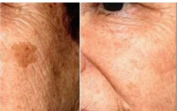 POZNATI DERMATOLOG OTKRIO: Ovo je uloga sode bikarbone u liječenju mrlja na licu!