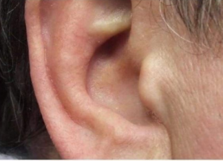 KAKO SIGURNO UKLONITI UŠNI VOSAK: METODE PREPORUČENE OD PEDIJATRA DR. GILA