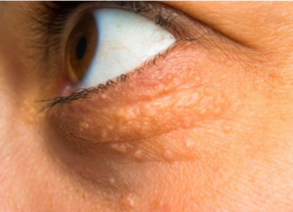 STAVILA SAM OVU NAMIRNICU NA MASNO TKIVO KOD OKA, ono je preko noći nestalo: EVO ŠTA ME SPASILO, SVI GA IMATE U KUĆI