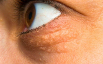 STAVILA SAM OVU NAMIRNICU NA MASNO TKIVO KOD OKA, ono je preko noći nestalo: EVO ŠTA ME SPASILO, SVI GA IMATE U KUĆI