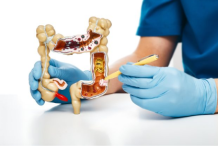 Prvi znakovi raka debelog crijeva koje žene ignoriraju!
