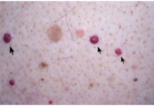 IMATE LI OVE CRVENE TAČKICE NA TIJELU? To nisu popucali kapilari, evo o čemu je zaista riječ