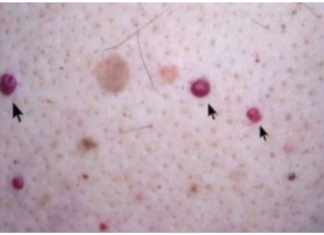 IMATE LI OVE CRVENE TAČKICE NA TIJELU? To nisu popucali kapilari, evo o čemu je zaista riječ