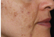 Evo kako da sa ovim jednostavnim trikom od 2 sastojka izbrišete mrlje s kože!