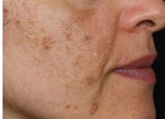 Evo kako da sa ovim jednostavnim trikom od 2 sastojka izbrišete mrlje s kože!