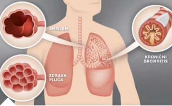 NAŠE BAKE SU NAJBOLJE ZNALE: Evo kako izliječiti astmu, bronhitis i plućne bolesti