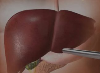 OVA HRANA UNIŠTAVA JETRU SKORO ISTO KOLIKO I ALKOHOL: 5 namirnica čiji unos morate ograničiti