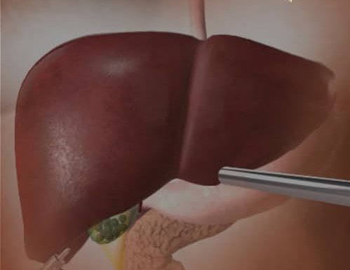 OVA HRANA UNIŠTAVA JETRU SKORO ISTO KOLIKO I ALKOHOL: 5 namirnica čiji unos morate ograničiti