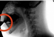 OVAJ OTROV UNIŠTAVA VAŠE KOSTI: Većina ga konzumira barem jednom dnevno