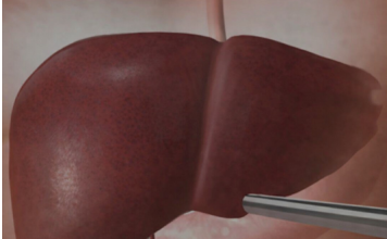 Jetra pod pritiskom: namirnice koje je opterećuju gotovo kao alkohol