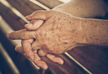 PRIMJETILI STE DA VAM SE POJAVLJUJU STARAČKE PJEGE : To je znak da imate ozbiljan problem sa jednim organom!