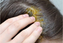 BUBULJICE NA GLAVI SU SVE ČEŠĆI PROBLEM: Ni slučajno ih ne istiskujte, evo zašto se javljaju I ŠTA TREBATE URADITI DA NESTANU