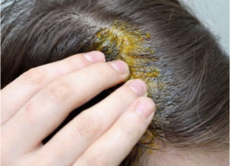 BUBULJICE NA GLAVI SU SVE ČEŠĆI PROBLEM: Ni slučajno ih ne istiskujte, evo zašto se javljaju I ŠTA TREBATE URADITI DA NESTANU