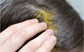 BUBULJICE NA GLAVI SU SVE ČEŠĆI PROBLEM: Ni slučajno ih ne istiskujte, evo zašto se javljaju I ŠTA TREBATE URADITI DA NESTANU