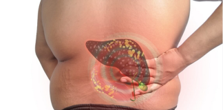 Sve veći broj ljudi ima masnu jetru: Uzrok nije alkohol, već jedan sastojak za koji svi misle da je zdrav