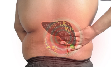 Sve veći broj ljudi ima masnu jetru: Uzrok nije alkohol, već jedan sastojak za koji svi misle da je zdrav