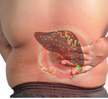 Sve veći broj ljudi ima masnu jetru: Uzrok nije alkohol, već jedan sastojak za koji svi misle da je zdrav