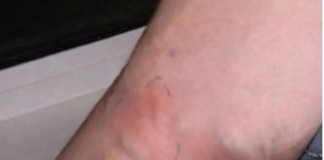 OVE SIMPTOME NIKAKO NE IGNORIŠITE! To je znak da se u tijelu formira TROMB opasan po ŽIVOT