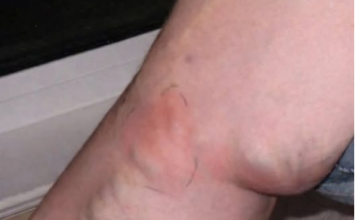 OVE SIMPTOME NIKAKO NE IGNORIŠITE! To je znak da se u tijelu formira TROMB opasan po ŽIVOT