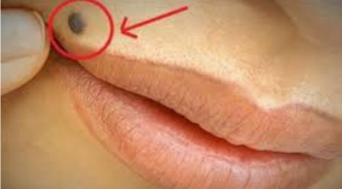 OTKRIJTE ISTINU Šta znači ako imate mladež na licu, ruci ili stopalu