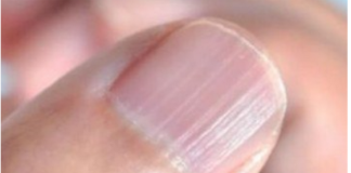 IMATE LI OVAKVE IZBOČINE NA NOKTIMA – evo šta one znače: Doktorica otkrila i možda ćete se iznenaditi