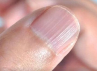 IMATE LI OVAKVE IZBOČINE NA NOKTIMA – evo šta one znače: Doktorica otkrila i možda ćete se iznenaditi