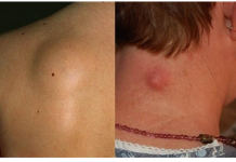 Šta su LIPOMI i da li su opasni? Evo kada je neophodno njihovo uklanjanje