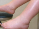 DA IZBACITE VIŠAK VODE POTREBAN VAM JE JEDAN VITAMIN: Ni noge vam više neće oticati, samo ga ubacite u ishranu