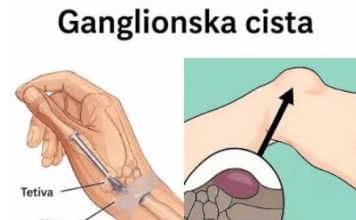 Ova kvržica se može pojaviti zbog nečega što radite svaki dan…