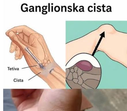 Ova kvržica se može pojaviti zbog nečega što radite svaki dan…