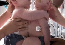 Ove sijamske blizanke rođene su spojene u području prsa i trbuha…Zbog načina na koji su njihova tijela bila povezana, čak su im i jednostavni pokreti poput uspravnog sjedenja, okretanja ili udobnog ležanja bili iznimno teški… - featured image