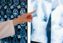 Znanstvenici otkrili što višestruko povećava rizik od raka pluća, posebno kod nepušača